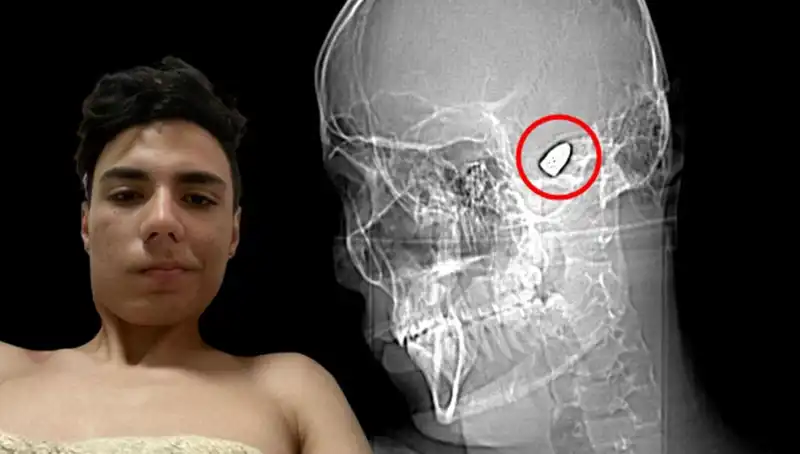 Kafasında Patlayan Bomba Endişesiyle Yaşayan Genç: Bir Yaşam Mücadelesi